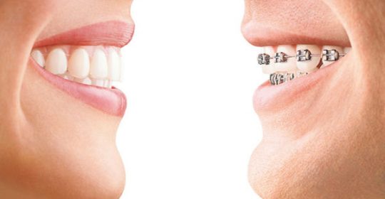 Aligneurs vs Brackets Reding Arlon 540x280 Orthodontie