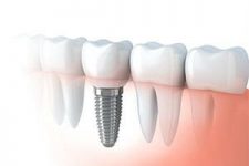 implant dentaire reding arlon 225x150 Spécialisations