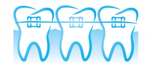 41. Orthodontie et appareils Info 300x138 Lorthodontie et les appareils dentaires