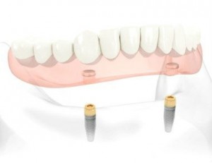 prothèse amovible implant 300x231 Conseils dhygiène pour prothèse dentaire amovible