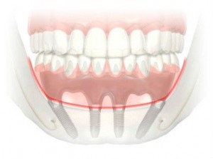 prothèse fixe implant 300x223 Les prothèses dentaires sur implants