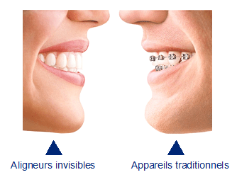 Aligneurs invisibles ortho photo Reding Traitements orthodontiques par aligneurs invisibles (VIDEO)
