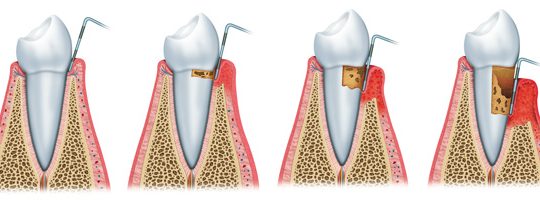 Parodontie dents 540x200 Parodontologie